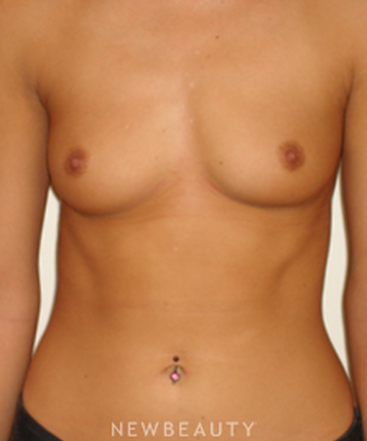 dr-michael-horn-breast-augmentation-b
