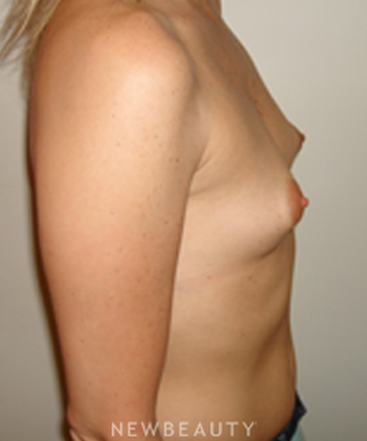 dr-michael-horn-breast-augmentation-b
