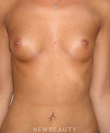 dr-michael-horn-breast-augmentation-b