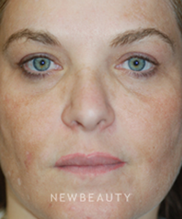 dr-kenneth-beer-fraxel-skin-resurfacing-b