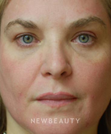 dr-kenneth-beer-fraxel-skin-resurfacing-b