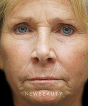 dr-kenneth-beer-aesthetic-injectables-b