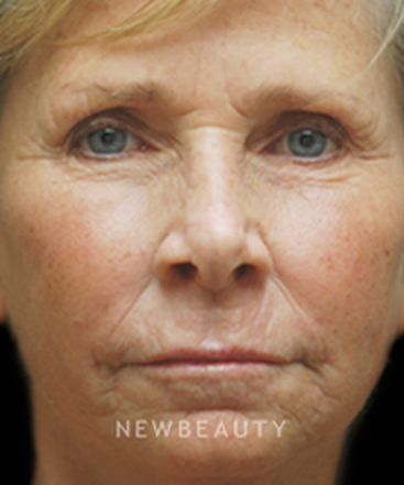 dr-kenneth-beer-aesthetic-injectables-b