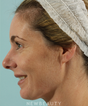 dr-marina-peredo-injectionsliquid-lift-b