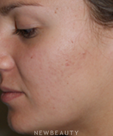 dr-marina-peredo-injectionsliquid-lift-b