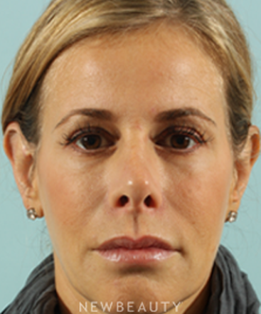 dr-marina-peredo-sculptra-b