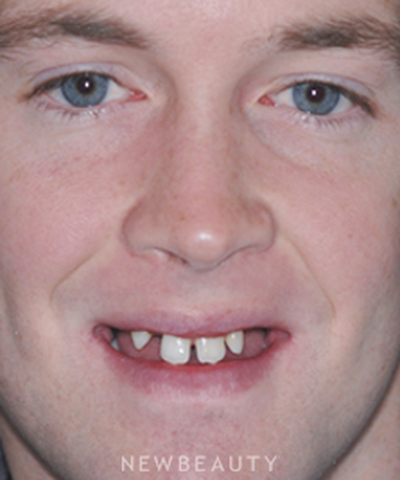 dr-ronald-goldstein-smile-makeover-b