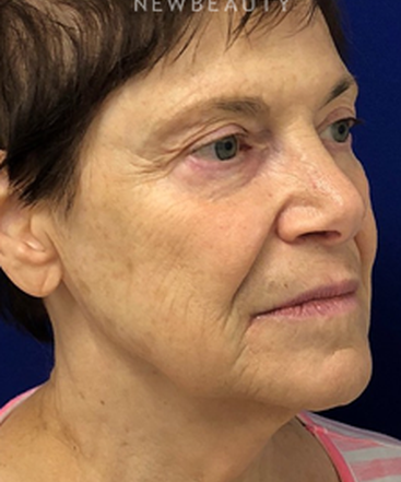 dr-dilip-madnani-facial-rejuvenation-b