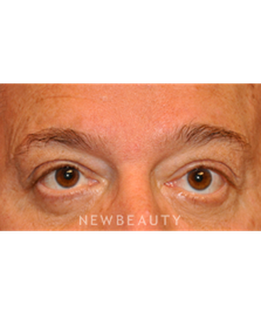 dr-baljeet-purewal-lower-blepharoplasty-b