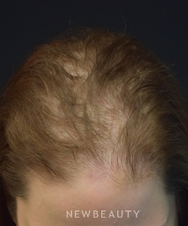 dr-jeffrey-b-wise-female-hair-loss-b
