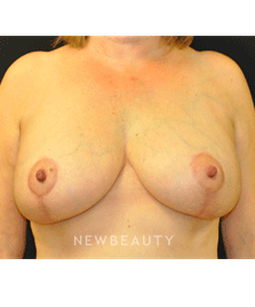 dr-andrew-smith-breast-augmentation-lift-b