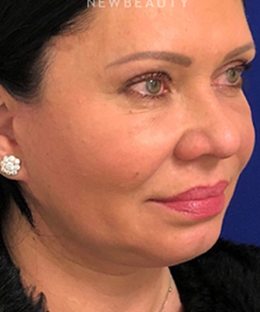 dr-dilip-madnani-facelift-necklift-b