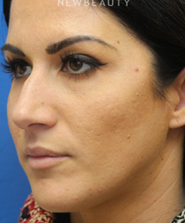 dr-jennifer-levine-rhinoplasty-b