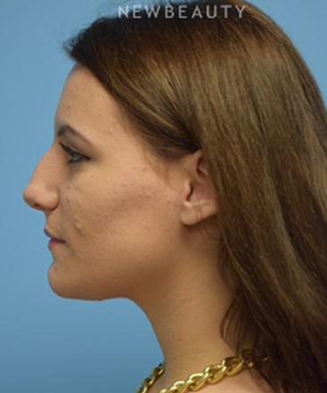 dr-jeffrey-b-wise-rhinoplasty-b