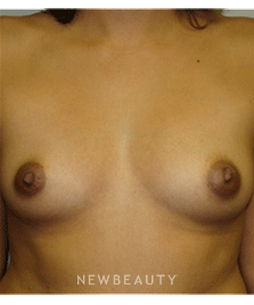 dr-sanjay-grover-breast-augmentation-b