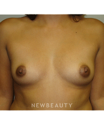dr-sanjay-grover-breast-augmentation-b