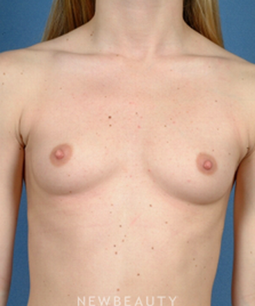 dr-bradley-calobrace-breast-augmentation-b