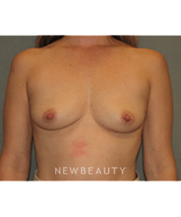 dr-sean-simon-breast-augmentation-b