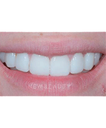 dr-guy-lewis-veneers-b