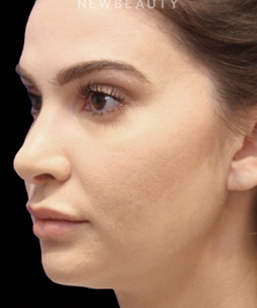 dr-jennifer-levine-rhinoplasty-b