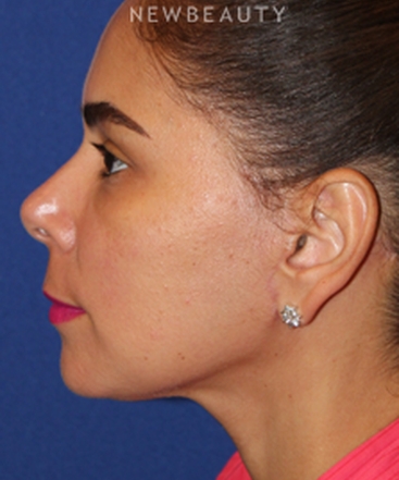 dr-dilip-d-madnani-mini-facelift-b