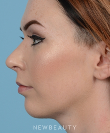 dr-jeffrey-wise-rhinoplasty-b