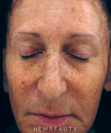 dr-kenneth-beer-ipl-laser-b