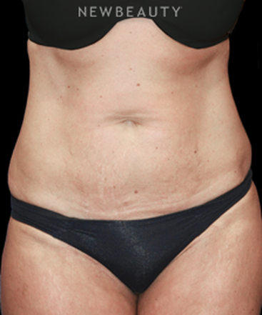 dr-bryan-w-gawley-tummy-tuck-with-lipo-b