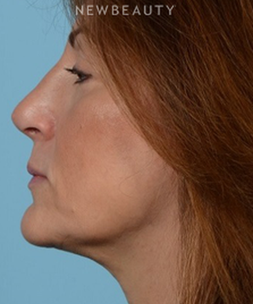 dr-jeffrey-wise-rhinoplasty-b