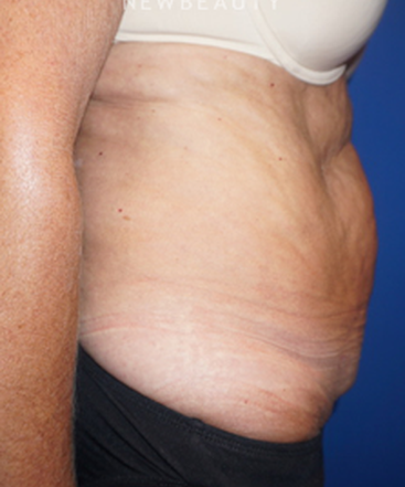 dr-niki-christopoulos-tummy-tuck-b