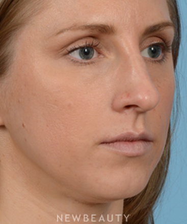 dr-jeffrey-wise-rhinoplasty-b