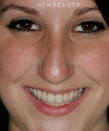 dr-laurence-rifkin-veneers-b