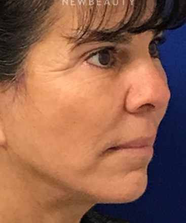 dr-dilip-madnani-facelift-necklift-b