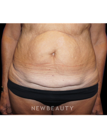 dr-niki-a-christopoulos-tummy-tuck-with-liposuction-b