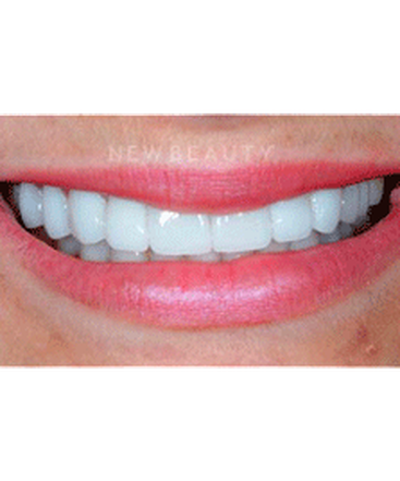 dr-guy-lewis-veneers-b