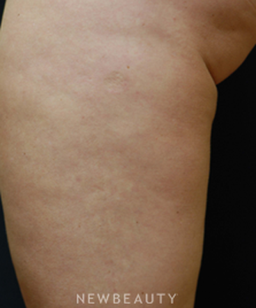 dr-kenneth-beer-lasers-cellulite-treatment-b