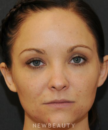 dr-janet-allenby-skin-treatments-b