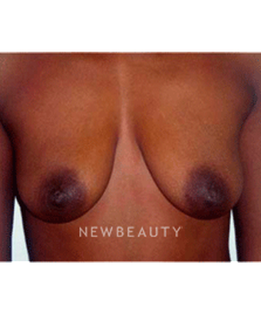 dr-michael-horn-breast-lift-b