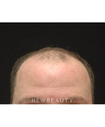 dr-jeffrey-b-wise-hair-transplant-b