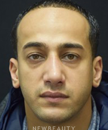 dr-jeffrey-b-wise-rhinoplasty-b