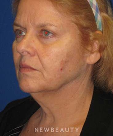 dr-dilip-d-madnani-facelift-necklift-b