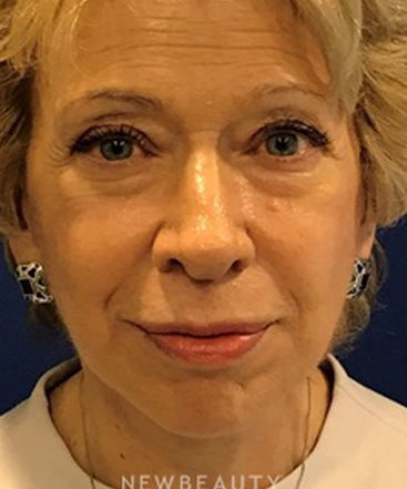 dr-dilip-madnani-facelift-with-fat-transfer-b