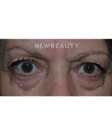 dr-baljeet-k-purewal-blepharoplasties-b