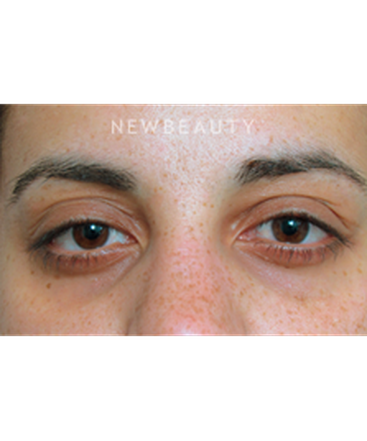 dr-raymond-douglas-under-eye-filler-b
