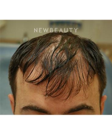 dr-jeffrey-rapaport-hair-transplant-b