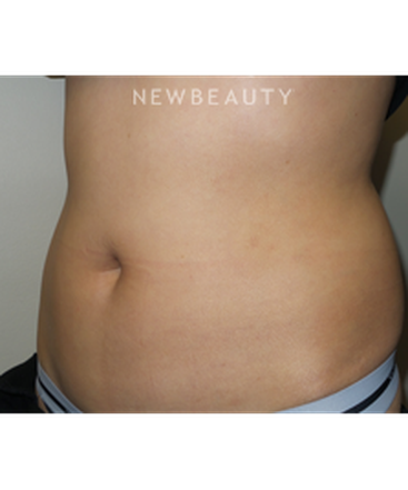 dr-sanjay-grover-coolsculpting-b