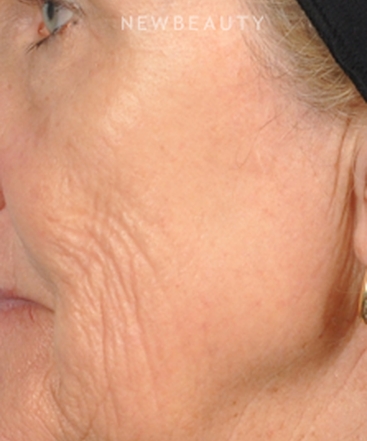dr-bradley-bengtson-skin-rejuvenation-b