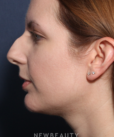 ljcsc-dr-wheeler-rhinoplasty-b