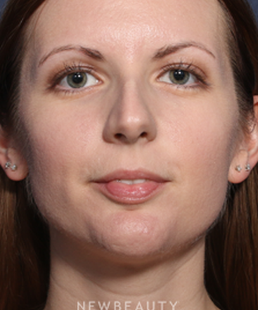 ljcsc-dr-wheeler-rhinoplasty-b