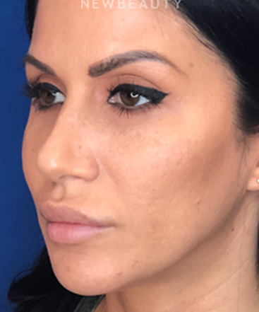 dr-jennifer-levine-rhinoplasty-b